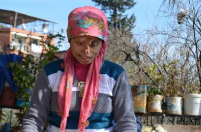 Yüzü yanan genç kadın, tedavisi için yardım bekliyor