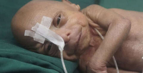 Bangladeş'te yaşlı bebek doğdu