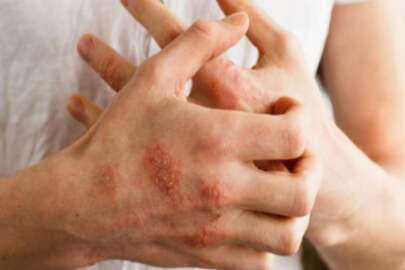 Egzama nedir? Egzama neden olur ve tedavi yöntemleri nelerdir?