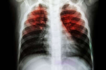 Bursa'da 'Verem' paniği! Hastalar nerede?