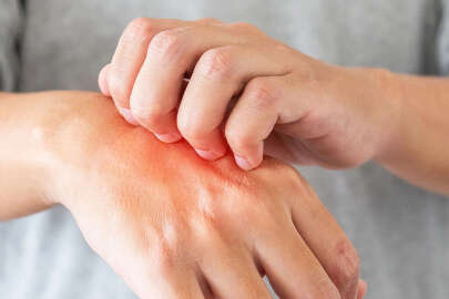 Soğuk yanıklarına dikkat! Bu şikayetleri hafife almayın... 