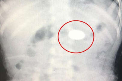 Bursa'da bozuk para yutan bebek ölümden döndü!