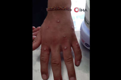 İstanbul'da 'Maymun Çiçeği' paniği...