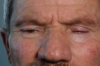 Trabzon'da 'Katarakt ameliyatı kör etti' iddiası!