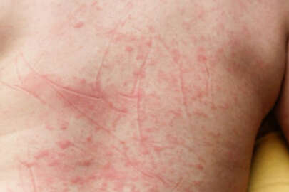 Strep A kabusu bitmeden şimdi de kızıl hastalığı!..