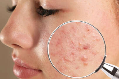 Sivilce lekeleri neden olur, nasıl geçer?