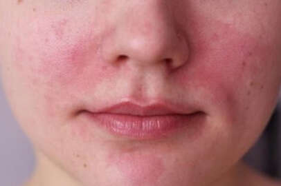 Cildin kurumasına engel olan 9 besin