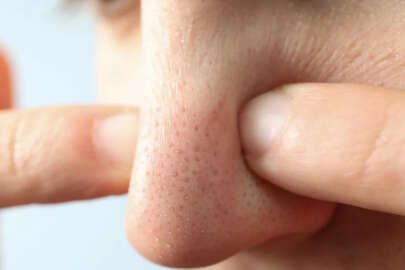 Siyah nokta neden olur ve nasıl geçer?