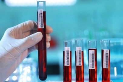 ASO nedir? ASO normal kan değeri kaç olmalıdır?