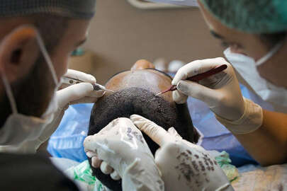 Saç ekimi birimleri hakkında yönetmelik değişiyor!