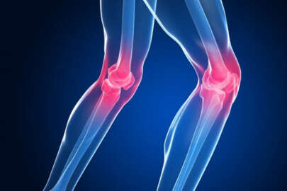 Diz kireçlenmesi rahatsızlığında yeni nesil tedavi!