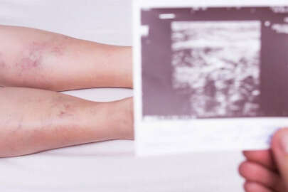 Sıcaklarda varise dikkat!