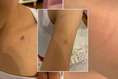 Anaokulunda öğretmenden rezalet! Çocuğunda morluklar görünce şoke oldu