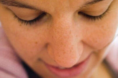 Cildinizde leke varsa doktora koşun: Kanser belirtisi olabilir