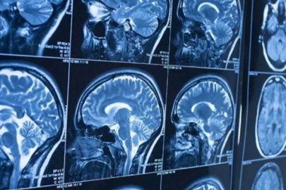 Umut verici araştırma: Beyin kanserine çare olabilir!
