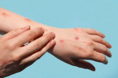 Maymun çiçeği virüsü İsveç'e sıçradı