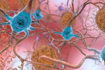 Araştırmacılardan Alzheimer'a karşı yeni yöntem