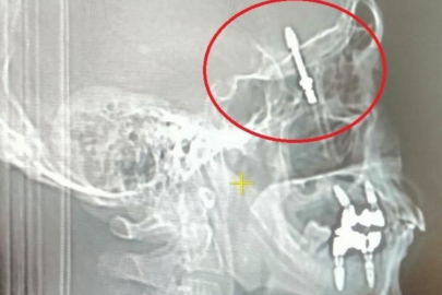 Bursa'da korkunç hata: İmplant hayatını kararttı