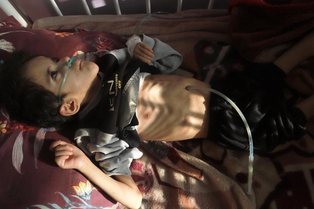 Yetersiz beslenme sorunu yaşayan Filistinli çocuk yaşam mücadelesi veriyor