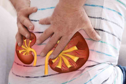 Böbrek taşı vakalarında kişiye özel tedavi