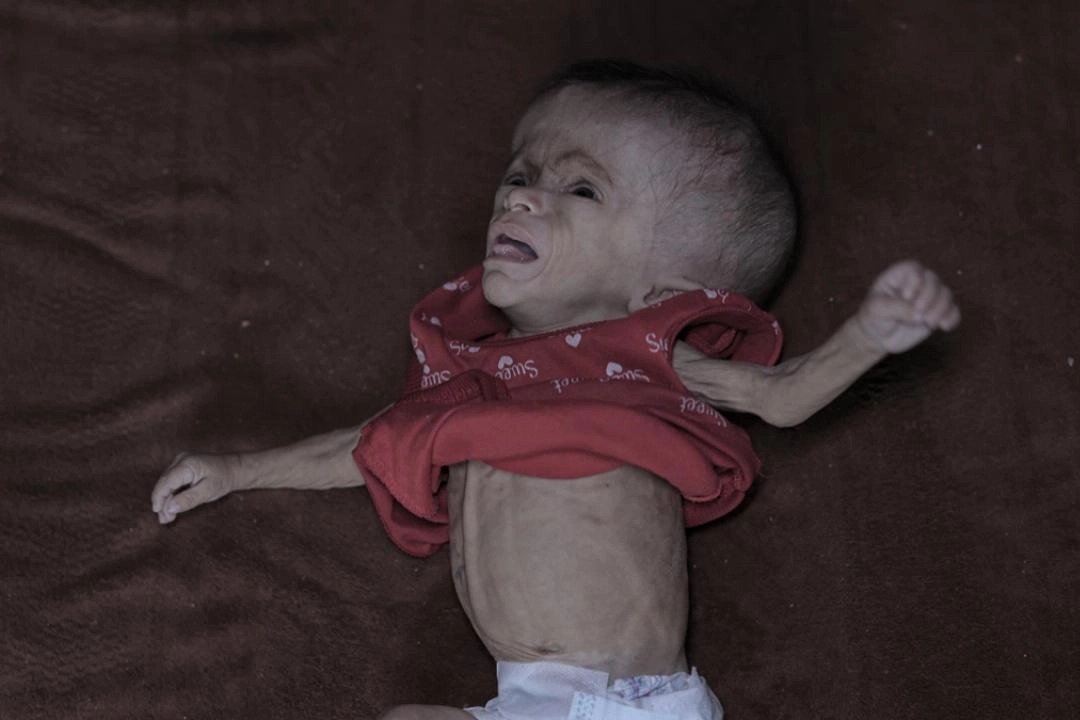 Yetersiz beslenme sorunu yaşayan Filistinli bebek, yaşam mücadelesi veriyor