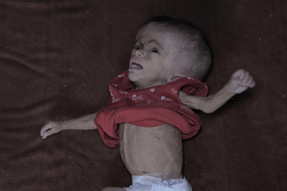 Yetersiz beslenme sorunu yaşayan Filistinli bebek, yaşam mücadelesi veriyor