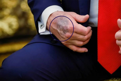 Trump'ın vücudunda bulunan morlukların nedeni belli oldu!