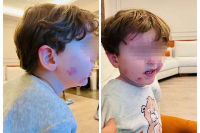 Bursa'da kreş skandalı: 2,5 yaşındaki çocuk darp edildi